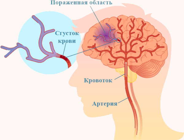 Анизокория это что в медицине. Причины, симптомы