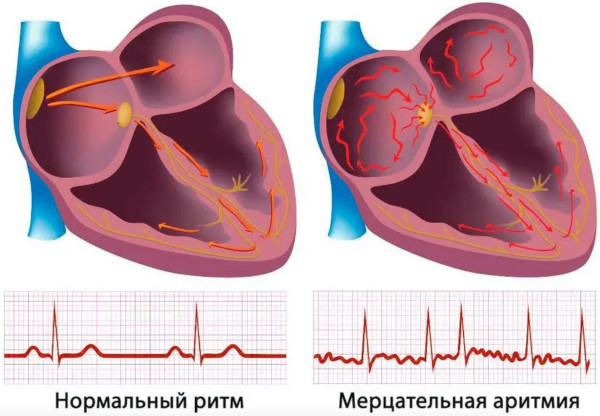 Антиаритмические препараты. Классификация, классы, механизм действия