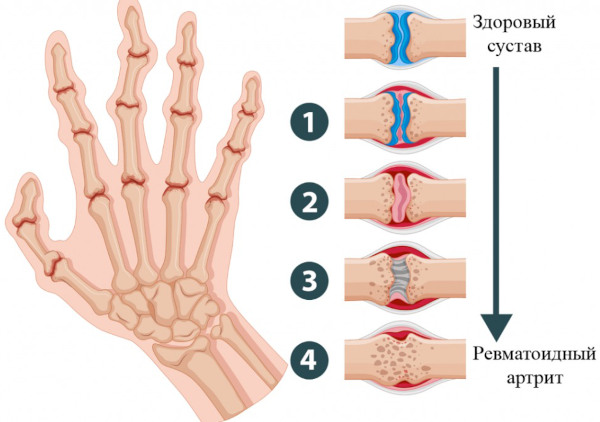 Артрофоон (Arthrofon) таблетки. Инструкция по применению, цена