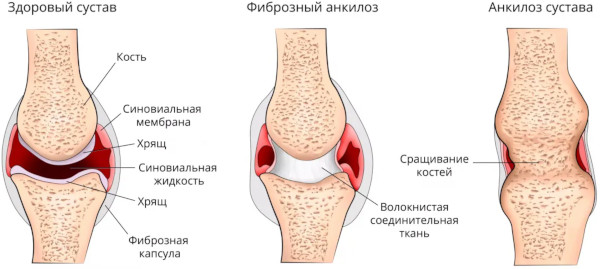 Артродарин (Artrodarin). Инструкция по применению, цена, отзывы