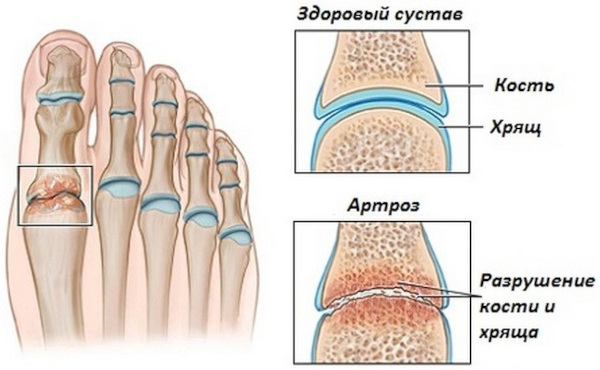 Артроз большого пальца ноги. Лечение народными средствами