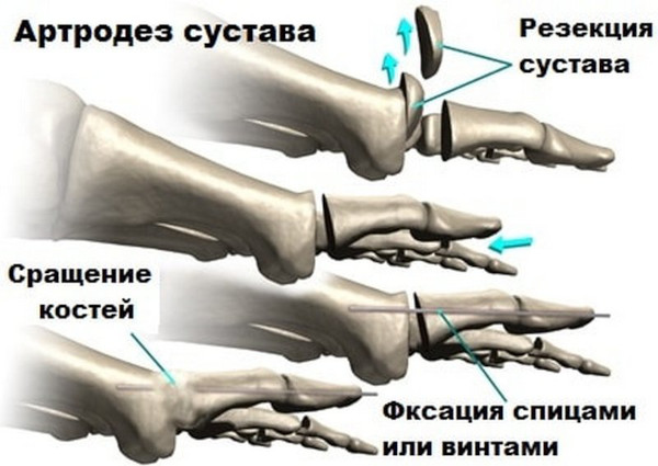 Артроз большого пальца ноги. Лечение народными средствами