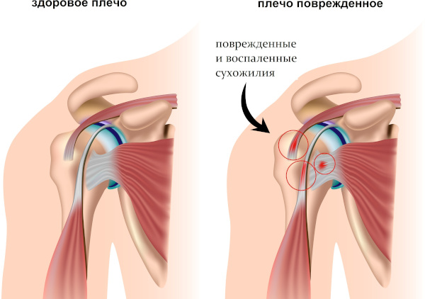 Бурсит плечевого сустава. Симптомы и лечение