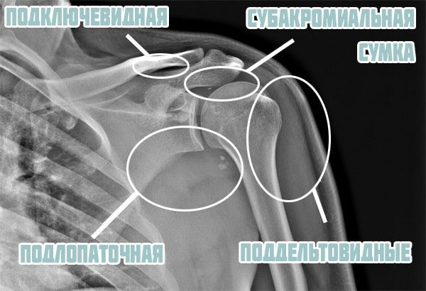 Бурсит плечевого сустава. Симптомы и лечение