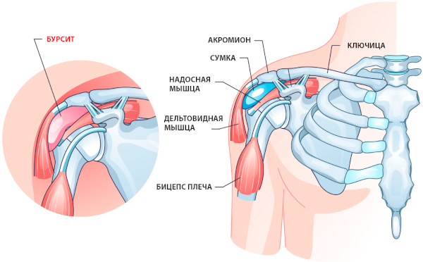 Бурсит плечевого сустава. Симптомы и лечение