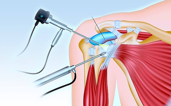 Бурсит плечевого сустава. Симптомы и лечение