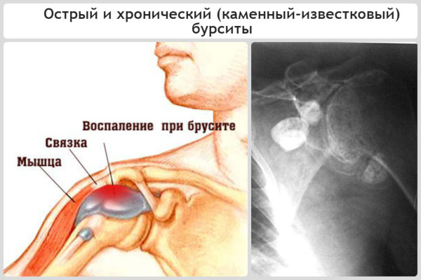 Бурсит плечевого сустава. Симптомы и лечение