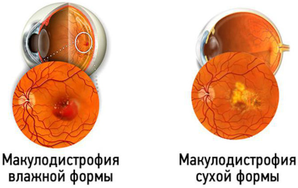 Дегенерация макулы (желтого пятна) и заднего полюса