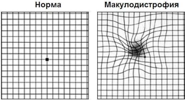 Дегенерация макулы (желтого пятна) и заднего полюса