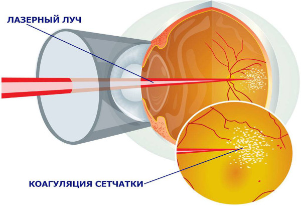 Дегенерация макулы (желтого пятна) и заднего полюса