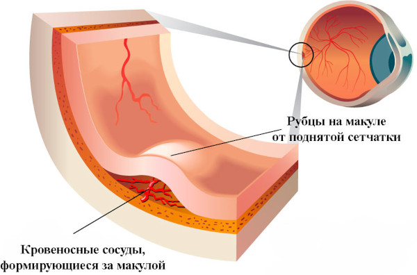 Дегенерация макулы (желтого пятна) и заднего полюса