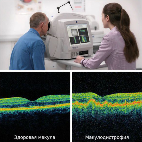 Дегенерация макулы (желтого пятна) и заднего полюса