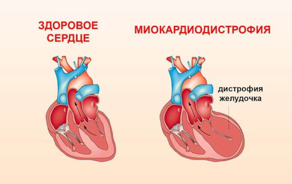 Дистрофия миокарда (миокардиодистрофия). Что это такое, симптомы, лечение