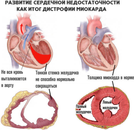 Дистрофия миокарда (миокардиодистрофия). Что это такое, симптомы, лечение