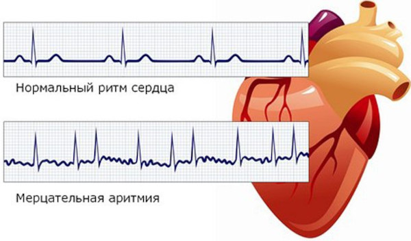 Дистрофия миокарда (миокардиодистрофия). Что это такое, симптомы, лечение