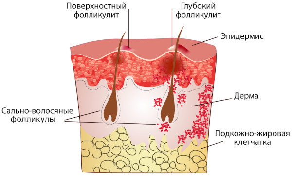 Фолликулит. Фото на ногах, коже, в паху, лечение