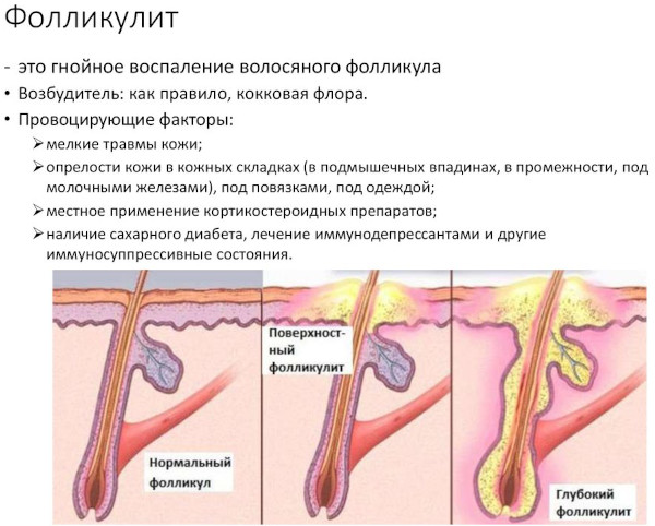 Фолликулит. Фото на ногах, коже, в паху, лечение