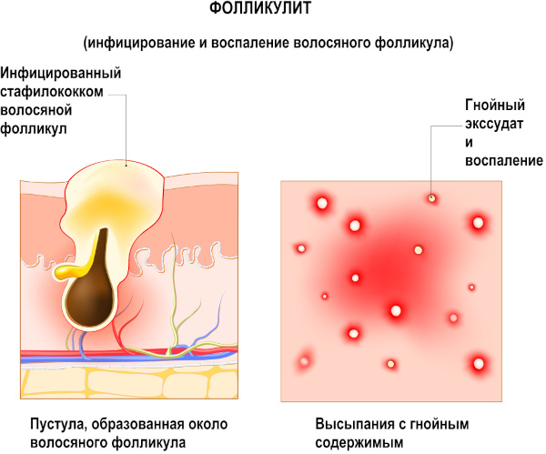Фолликулит. Фото на ногах, коже, в паху, лечение