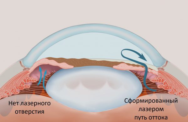 Гемолакрия что это за болезнь, причины, лечение