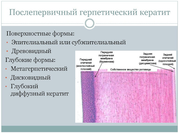 Кератит герпетический. Лечение, фото, сколько длится