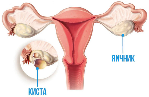 Киста яичника при беременности на ранних сроках