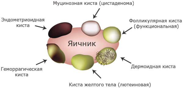 Киста яичника при беременности на ранних сроках