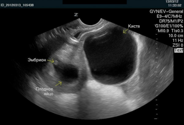 Киста яичника при беременности на ранних сроках