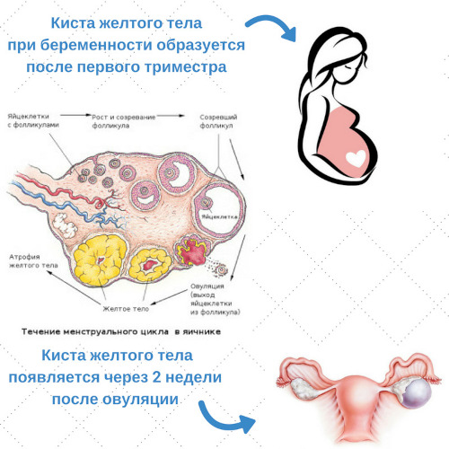 Киста яичника при беременности на ранних сроках