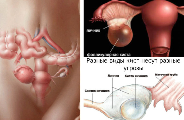 Киста яичника при беременности на ранних сроках