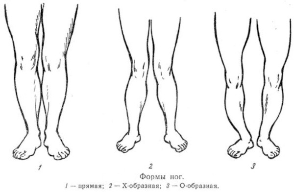 Кривые ноги у мужчин. Исправление, как выпрямить в коленях, упражнения