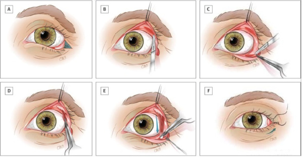 Лагофтальм это что в офтальмологии. Лечение