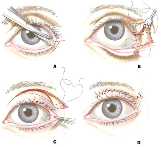 Лагофтальм это что в офтальмологии. Лечение