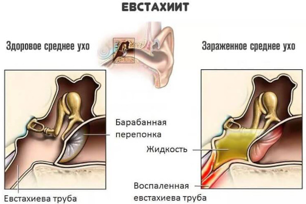 Лечение евстахиита у взрослых. Препараты, капли