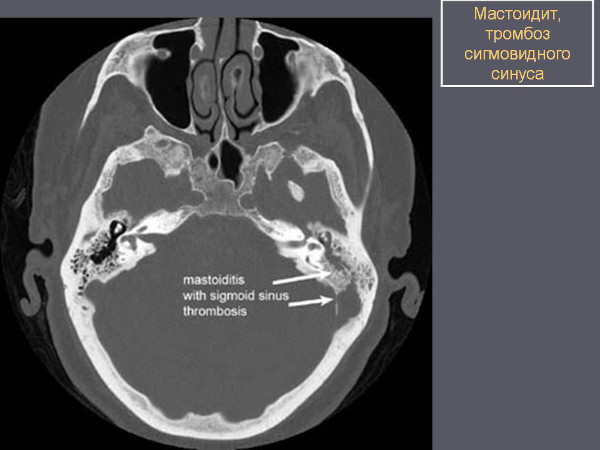 Мастоидит это что за болезнь. Симптомы, лечение