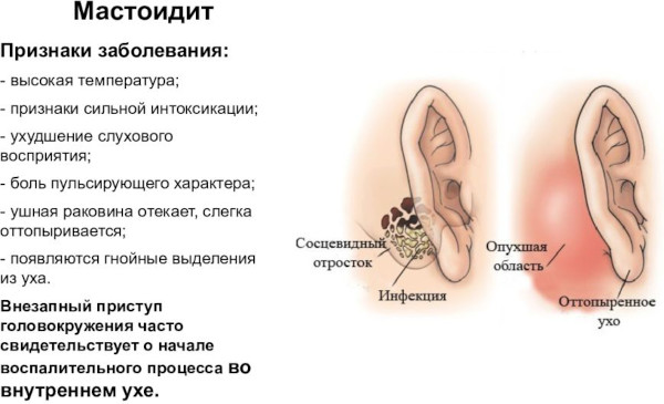 Мастоидит это что за болезнь. Симптомы, лечение