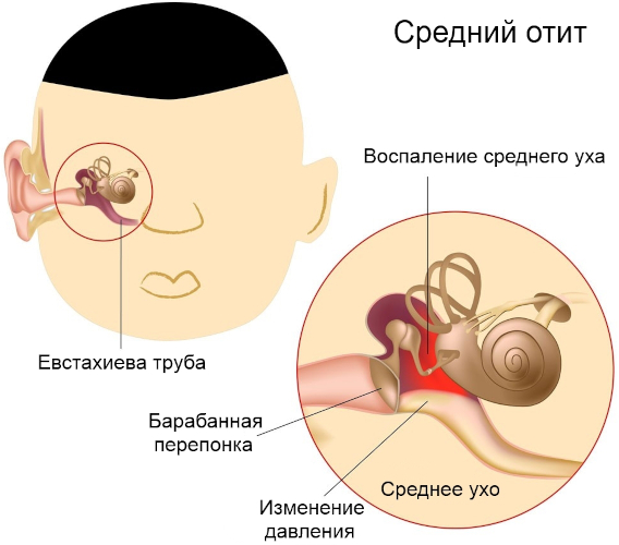 Мастоидит это что за болезнь. Симптомы, лечение