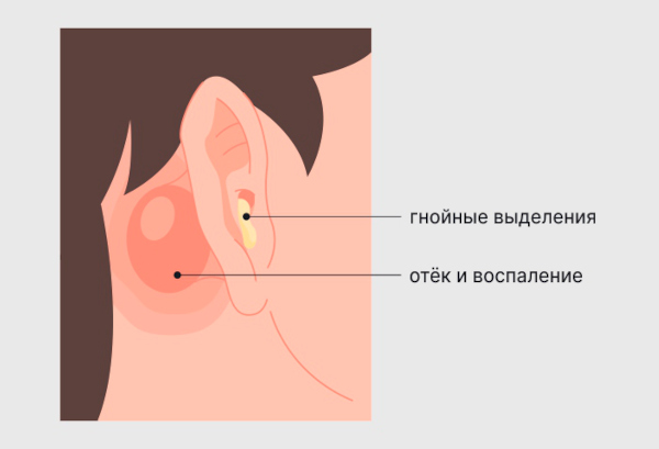 Мастоидит это что за болезнь. Симптомы, лечение