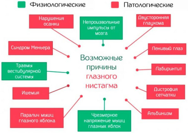 Нистагм глаз. Что это такое у взрослых, причины