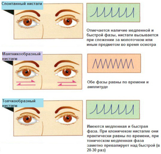 Нистагм глаз. Что это такое у взрослых, причины