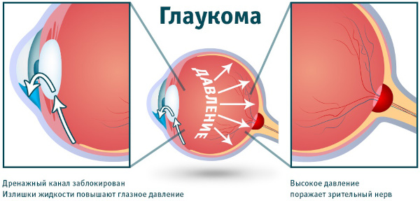 Оптическая когерентная томография глаза. Что это такое