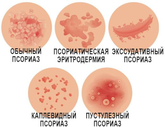 Оптидермал (Optidermal) мазь от псориаза. Цена, инструкция