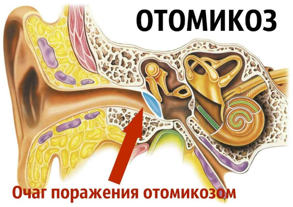 Отомикоз уха. Лечение: лекарства, препараты