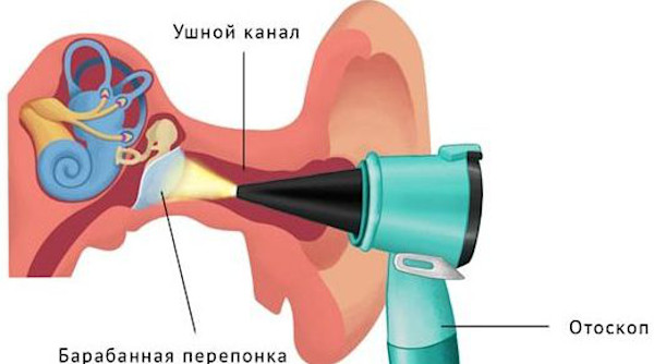 Отосклероз уха. Что это, симптомы, лечение, операция