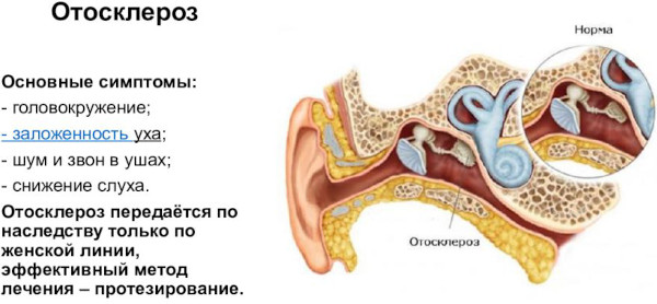 Отосклероз уха. Что это, симптомы, лечение, операция