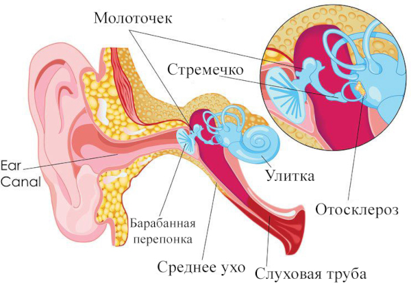 Отосклероз уха. Что это, симптомы, лечение, операция