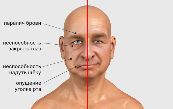 Отосклероз уха. Что это, симптомы, лечение, операция