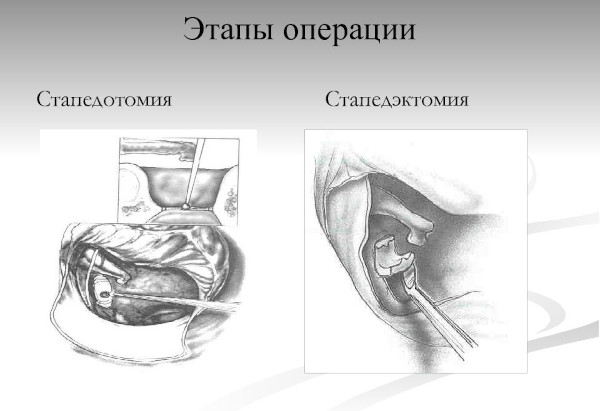 Отосклероз уха. Что это, симптомы, лечение, операция