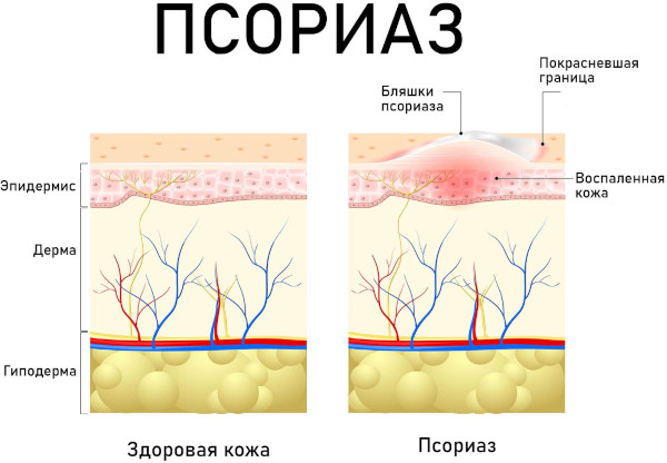 Питание при псориазе для женщины. Меню на каждый день