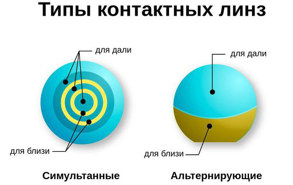 Пресбиопия глаз. Что это такое у взрослых, как лечить