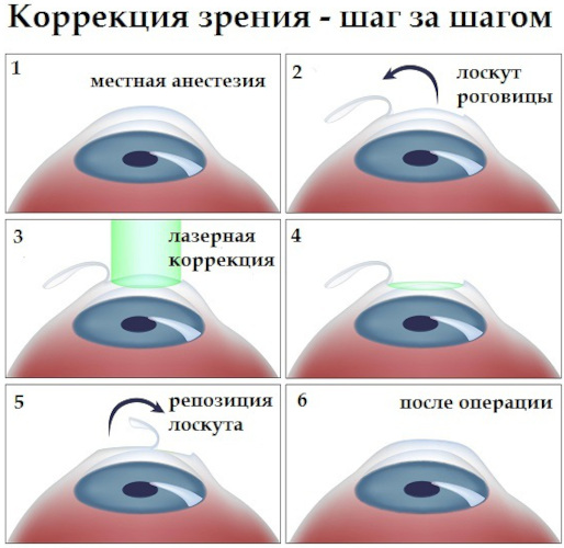 Пресбиопия глаз. Что это такое у взрослых, как лечить